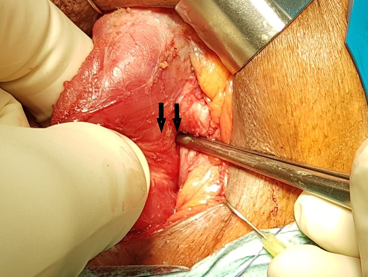 Dr. Collado Serra preserving bulbospongiosus muscle.