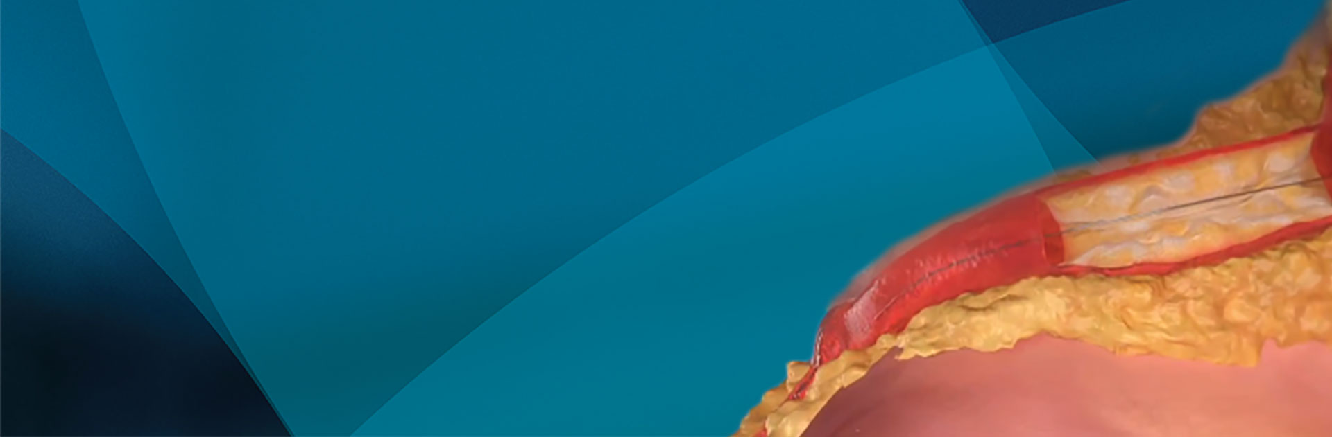 IVUS is necessary for every procedure