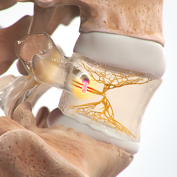Graphic depicting Intracept Basivertebral nerve ablation system.