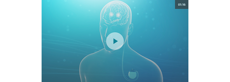 Discover how Deep Brain Stimulation therapy works