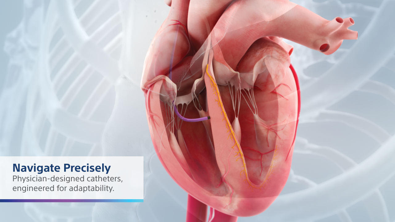 Interior heart illustration of the placement of a site selective pacing catheter moving into placement for coaxial positioning on the septum.