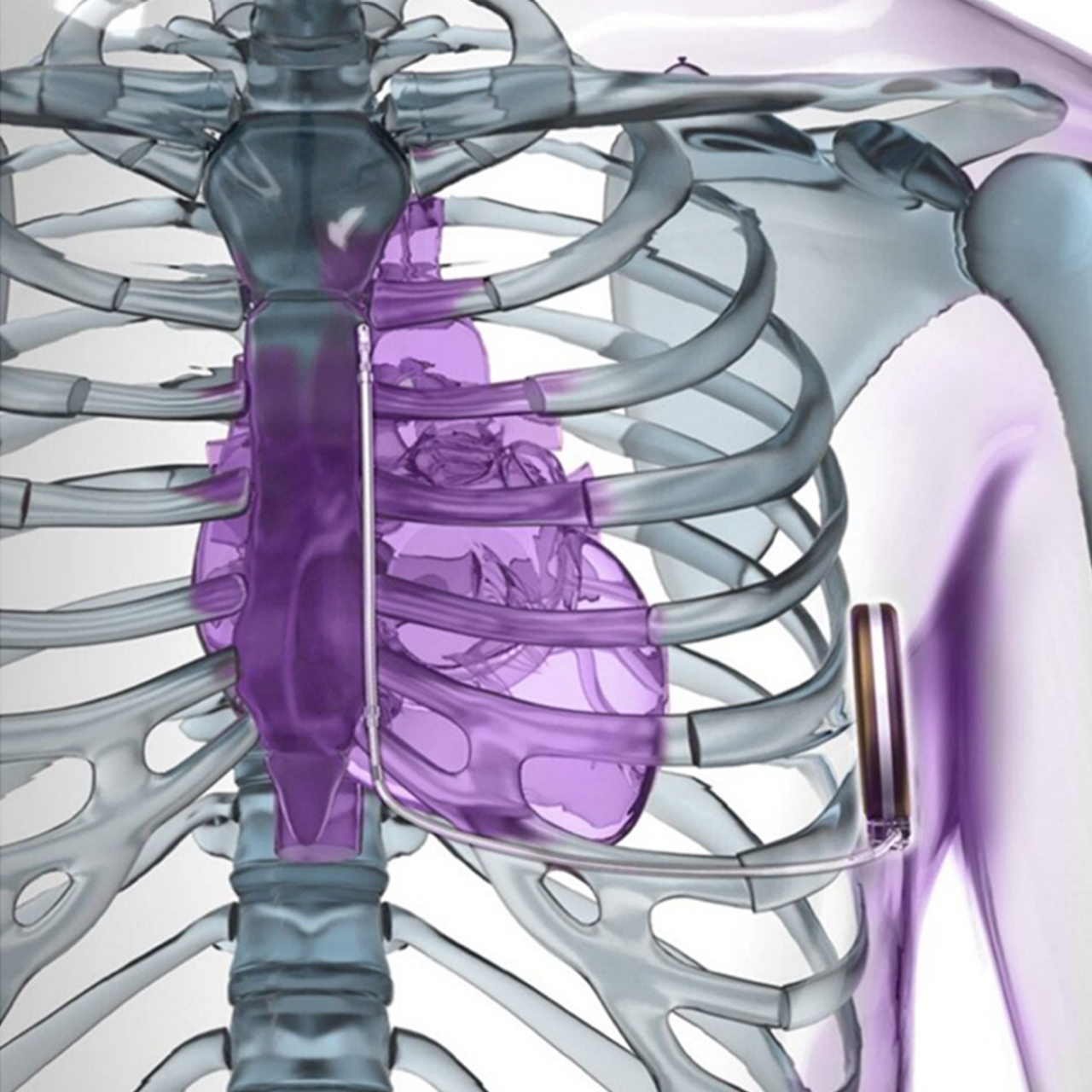 The Modular CRM System includes the EMBLEM S-ICD and the EMPOWER leadless pacemaker.