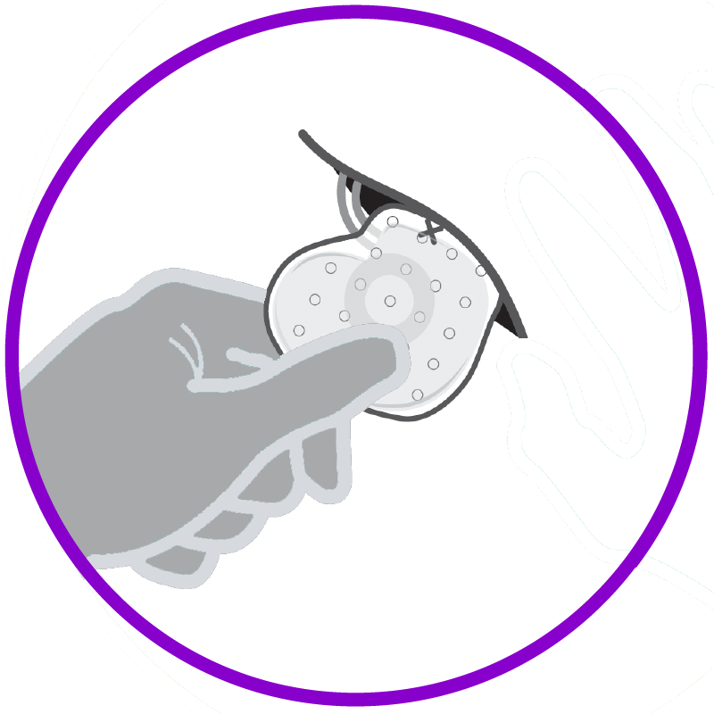 A BioEnvelope containing a CIED being positioned into the surgical chest pocket.  