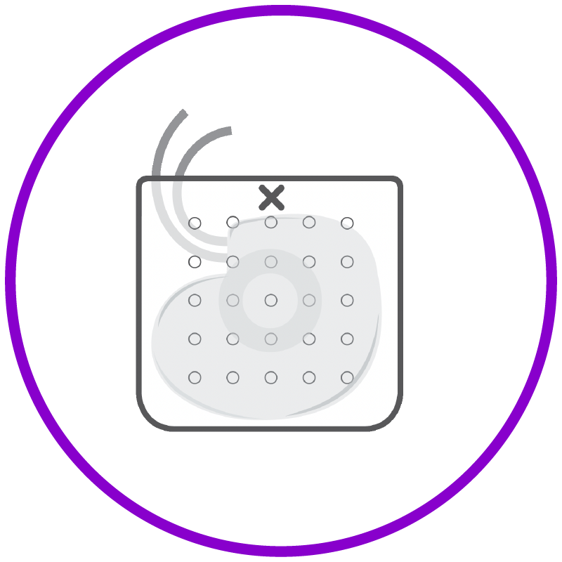 A CIED being inserted into a BioEnvelope with lead wires extending from the opening. 