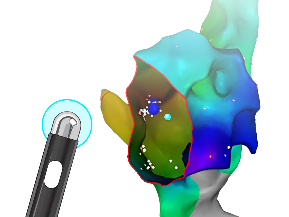 Black NRG Transseptal Needle, next to duomode map of organ.