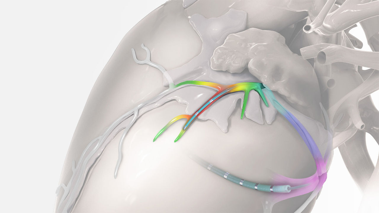 2F microcatheter telescoping out of 6F catheter with lumen into deeper coronary venous anatomy.