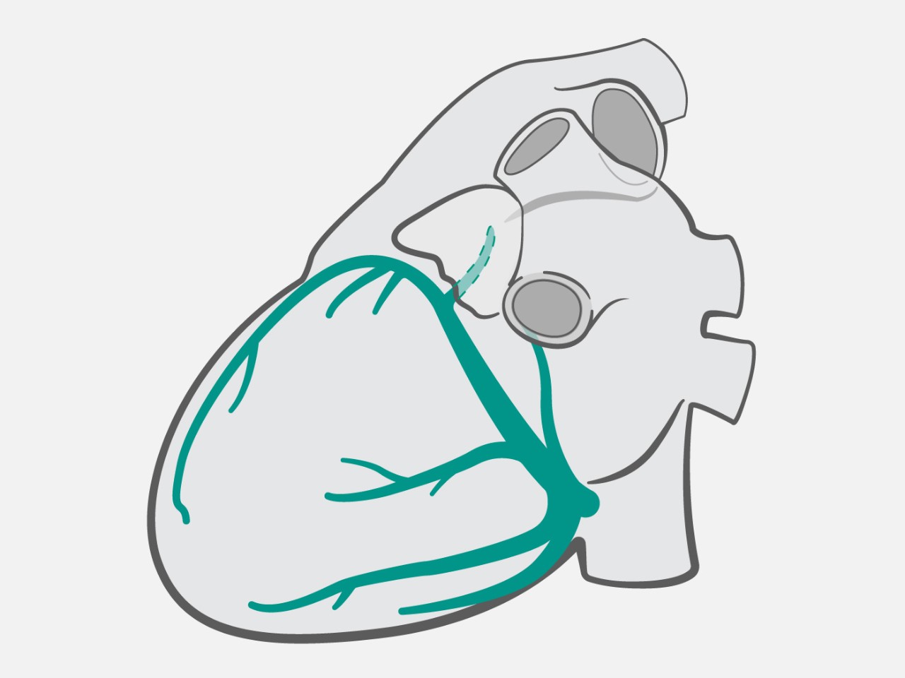 Diagram of heart showing communicating vein, vein of Marshall, and middle cardiac vein.