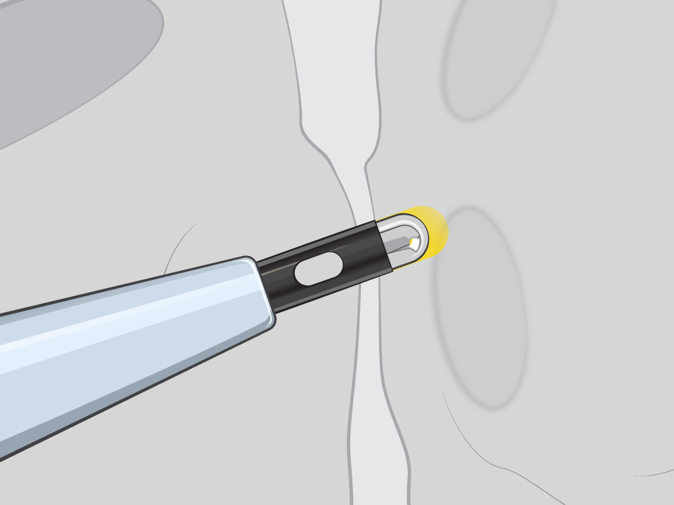NRG Transseptal Needle puncturing through the thin interatrial septum, glowing yellow at the tip.