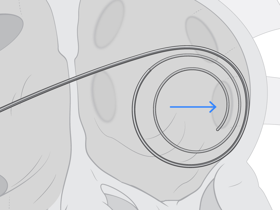 ProTrack Pigtail Wire cushioned against the left atrial wall.