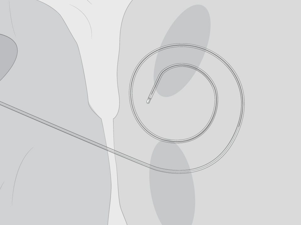 Flexible spiral tip of the SupraCross RF Wire helps to maintain left atrial access.