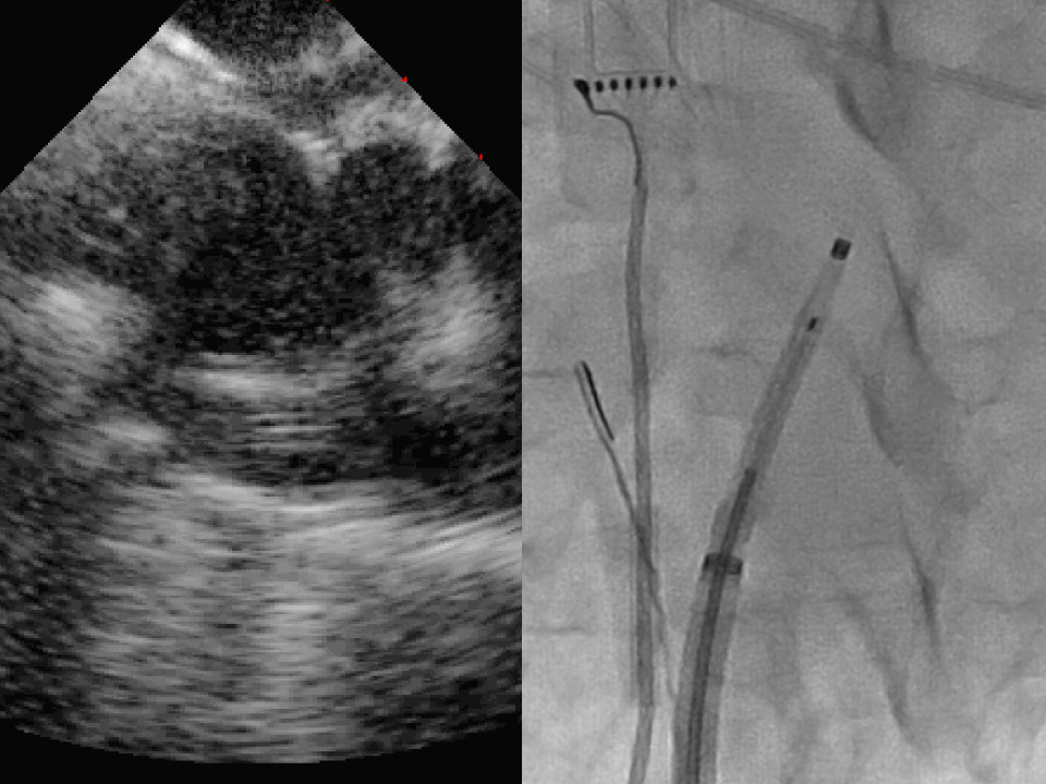 SureFlex sheath with dilator radiopaque tips to visualize location
