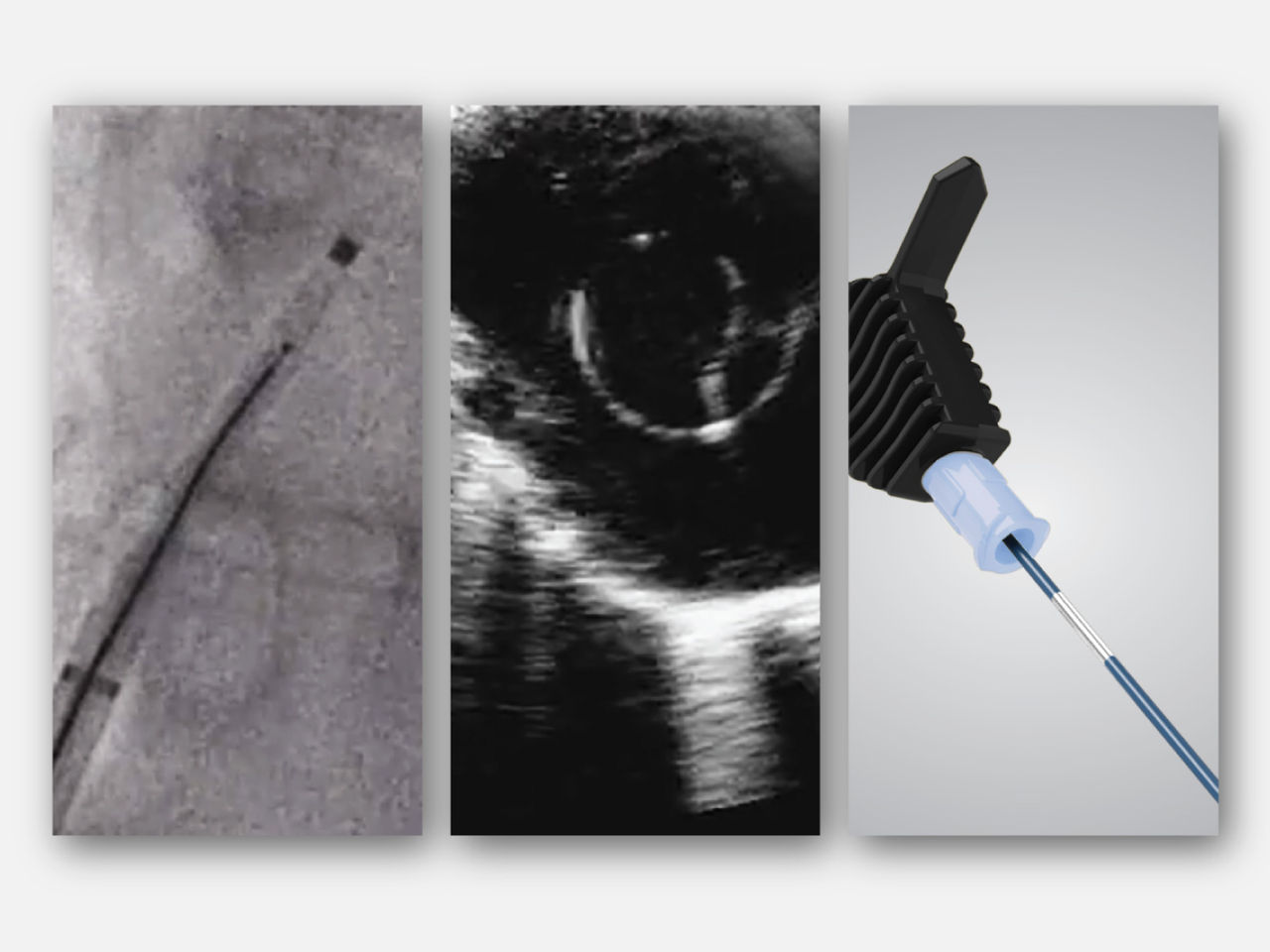 Fluoroscopic image of RF wire in sheath/dilator assembly.