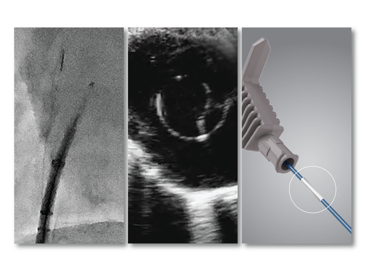 Fluoroscopic image of RF wire in sheath/dilator assembly.