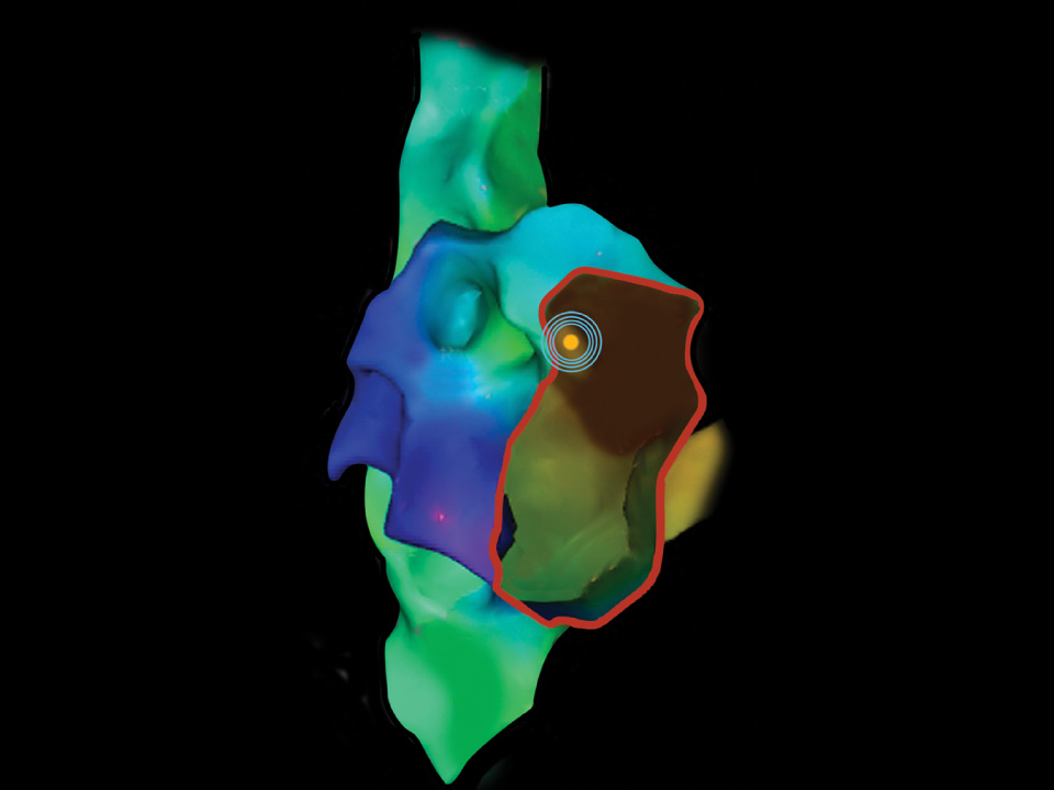 Mapping system showing location of VersaCross RF Wire tip.