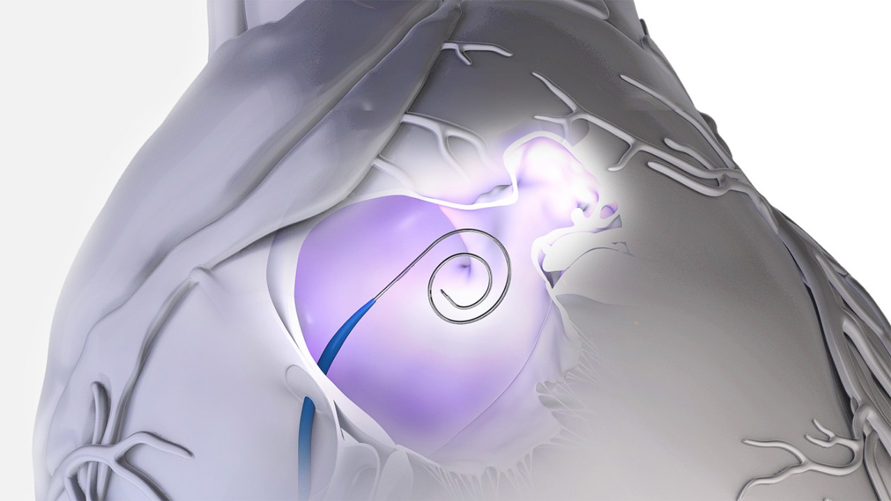 VersaCross Large Access Solution assembly with seamless dilator and exchangeless, 3-in-1 RF wire.