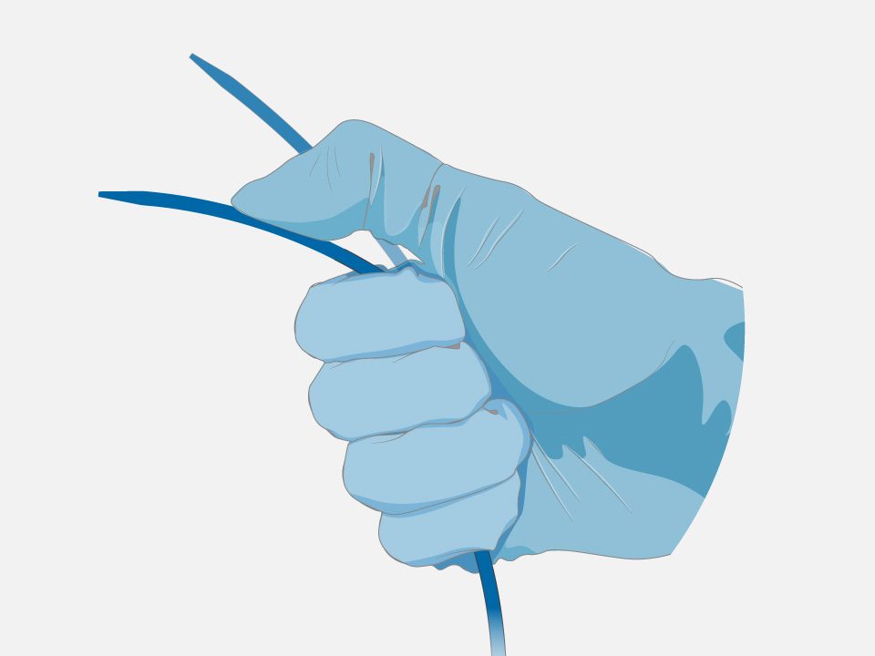 Hand in surgical glove bends the single, seamless transseptal dilator of the VersaCross Large Access Solution