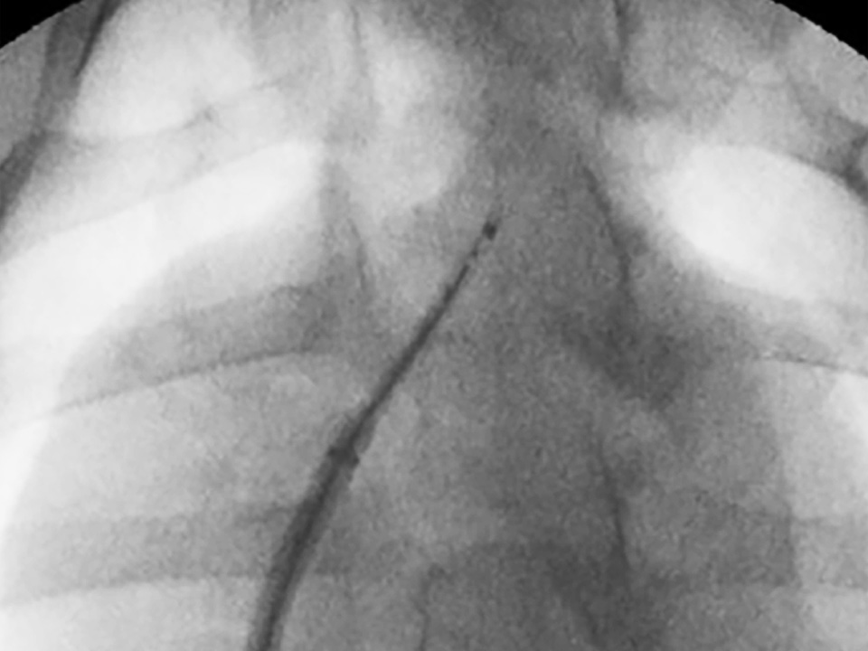 Image demonstrating that VersaCross Access Solution is radiopaque.