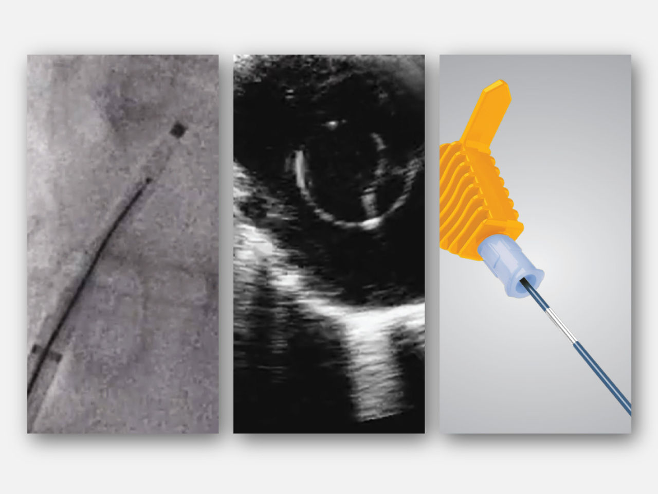 Fluoroscopic image of RF wire in sheath/dilator assembly.