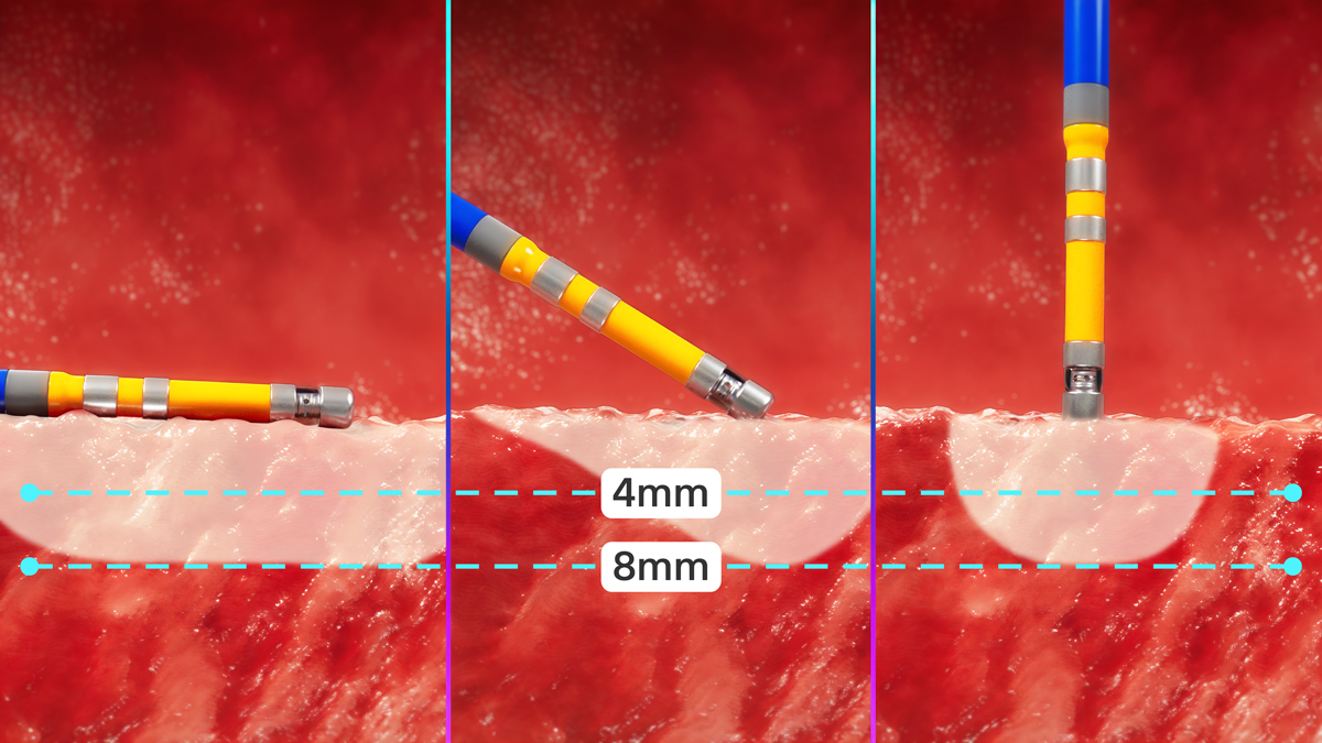 FARAPOINT Pulsed Field Ablation (PFA) Catheter delivers 8 mm lesion depth 