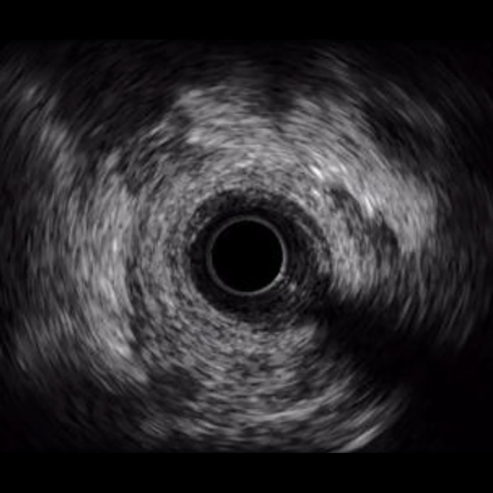 IVUS image of inside a coronary vessel using the 40MHz Opticross catheter