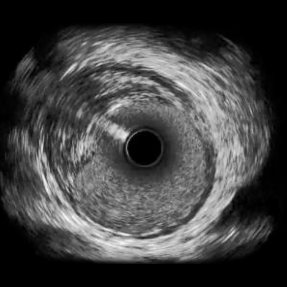 IVUS image of inside a coronary vessel using the 60MHz Opticross catheter