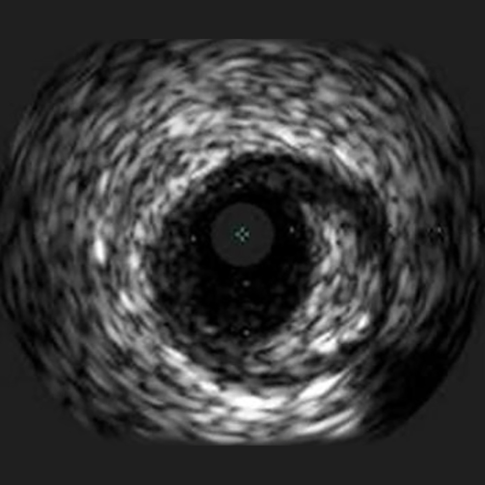 IVUS image of inside a coronary vessel using the 20MHz Philips Volcano Eagle Eye Platinum catheter