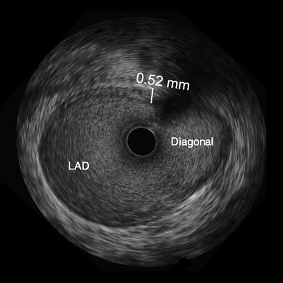High-definition IVUS image of inside a coronary lesion using the OPTICROSS HD catheter