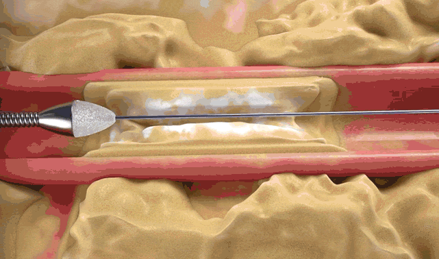 ROTAPRO Rotational Atherectomy Mechanism of Action Animation Breaking Calcium in Heavily Calcified Lesion