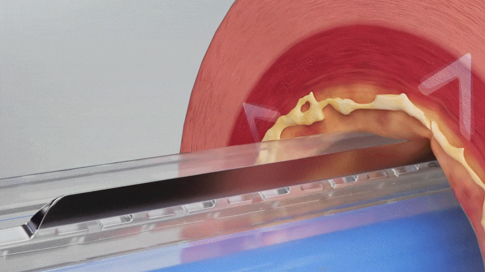 Illustration of WOLVERINE cutting balloon angioplasty device for complex lesion preparation and unmatched versatility.