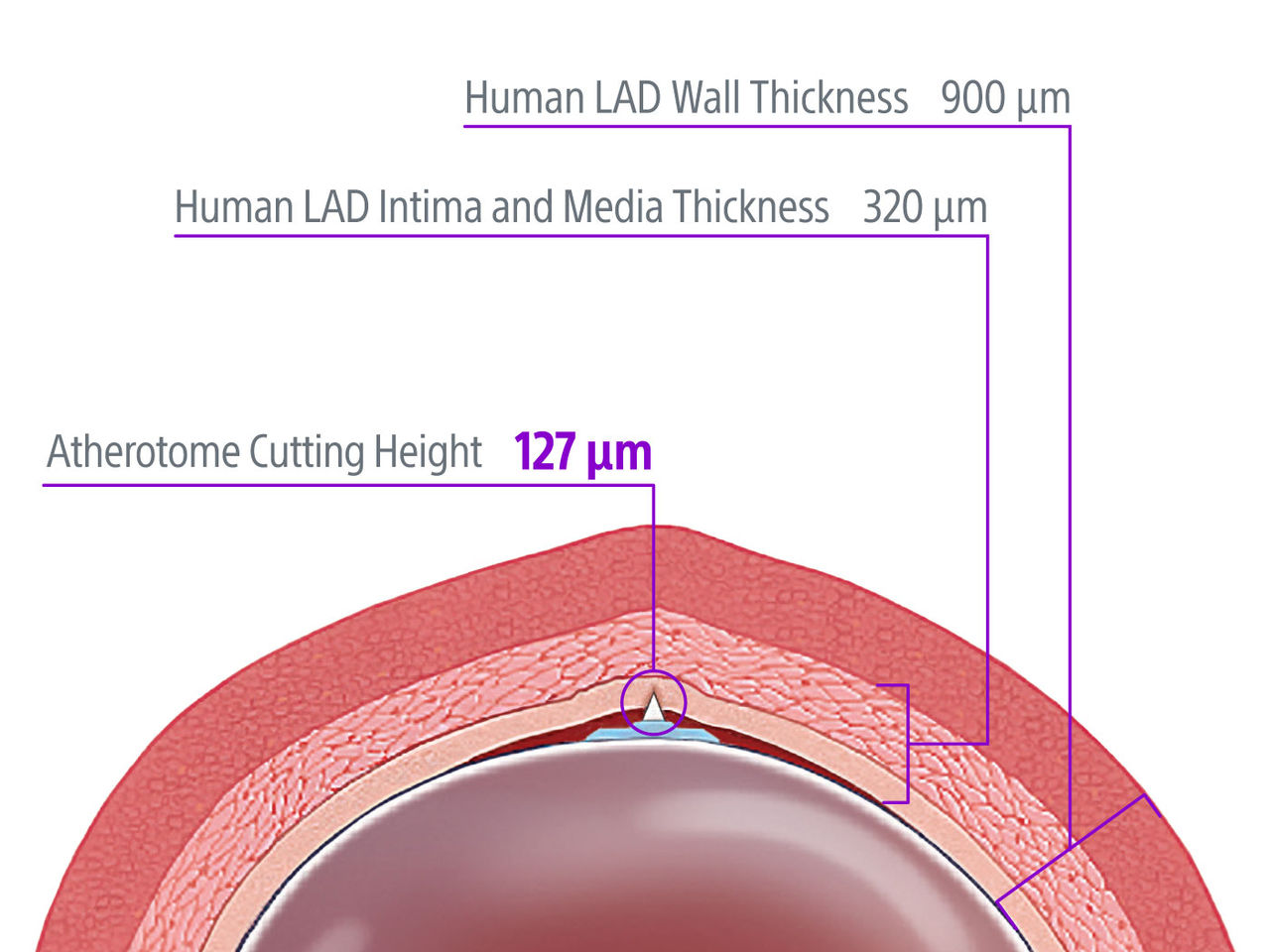 WOLVERINE atherotome image showing smaller profile coronary cutting balloon diagram in cross section of a calcified artery 