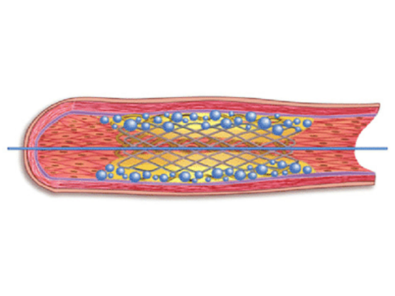 Polymer drug released from drug-eluting stent in the vessel to enable short DAPT.