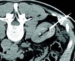 Treatment of lesion adjacent to colon