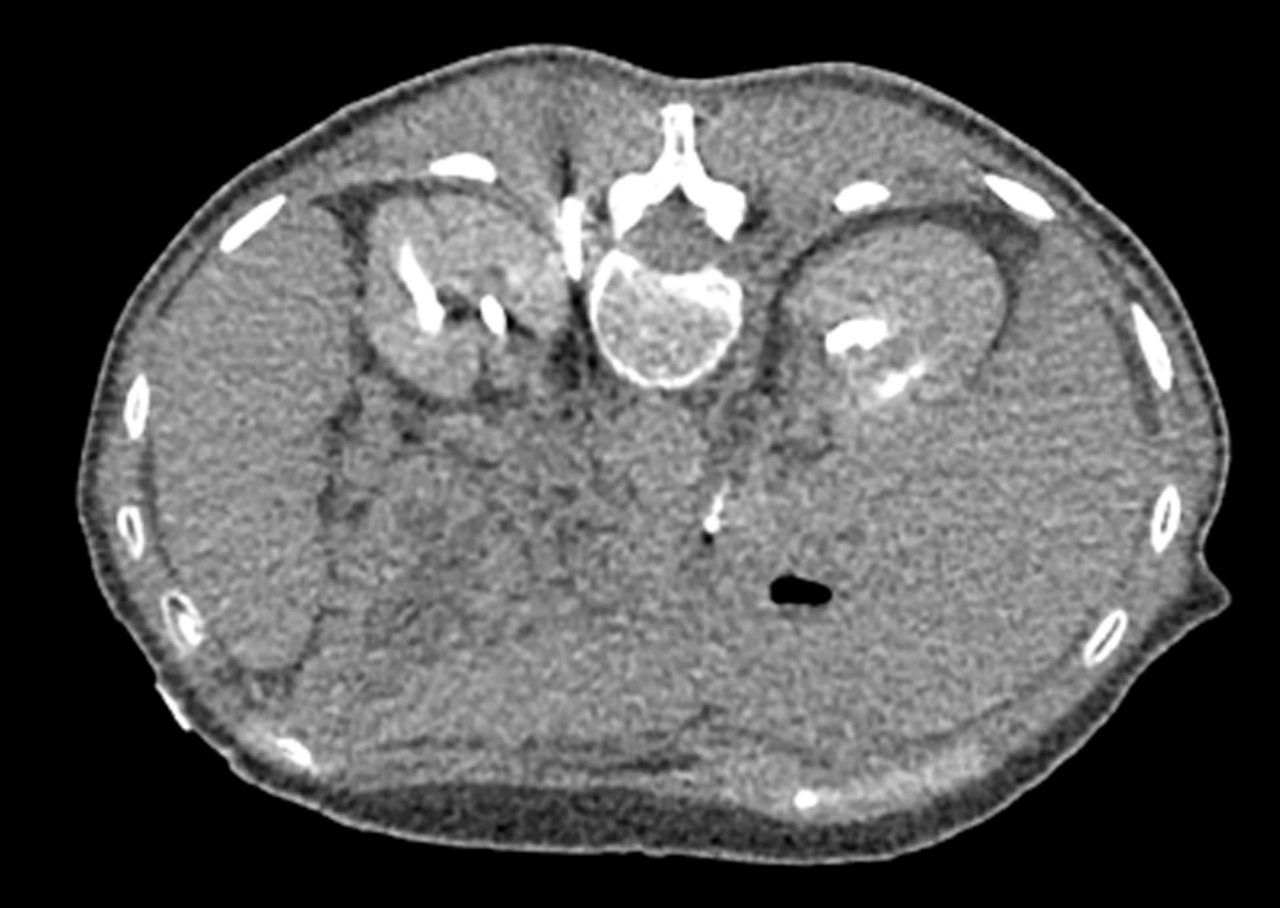 MRI image from Chary cryoneurolysis case