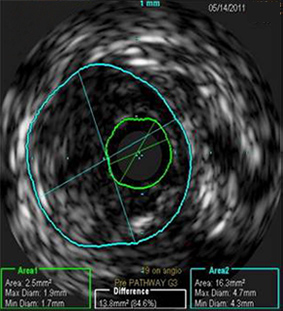 Pre-procedure CTO of right distal SFA/proximal popliteal. Baseline IVUS measurement reveals area of 2.5 mm²