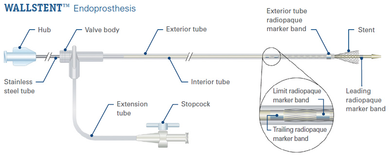Wallstent Endoprosthesis detailed graphic.