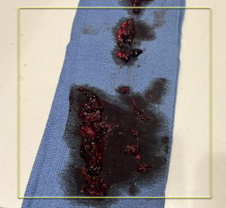 Multiple blood clots on blue cloth with yellow sqaure around clots.
