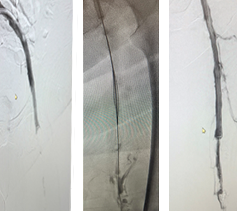 Scan of veins post-penumbra.