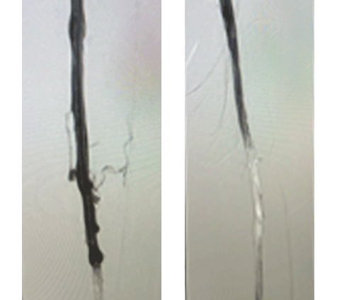Scans of veins post Smartclaw.