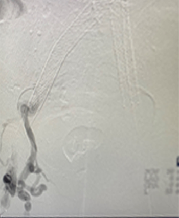Thrombus in vein shown in scan.
