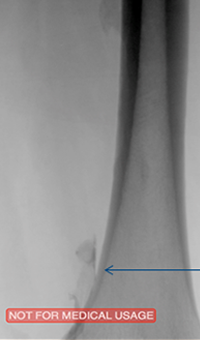 xray of femoral vein pre-treatment.