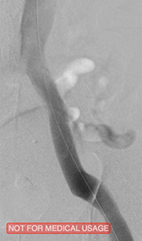 xray image of liac vein post-PTA & stent.