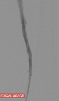 Femoral vein post-ZelanteDVT.