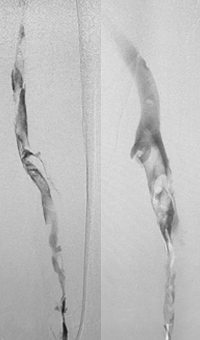 Acute DVT Left Lower Extremity Revascularization pre-treatment angio.
