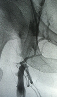 Xray of veins with one pass of treatment.