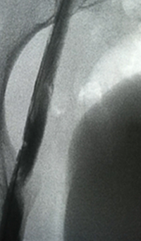 Xray of post-treatment.