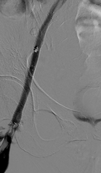Xray of veins post-treatment venogram.