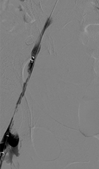 Xray of treatment with AngioJet Solent Omni catheter.