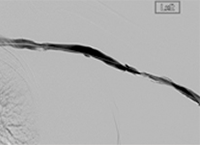 Thrombectomy of Left Brachiocephalic AV Fistula post-thrombectomy passes, PTA.