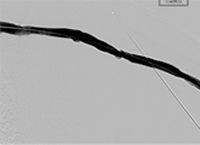 Thrombectomy of Left Brachiocephalic AV Fistula final result.