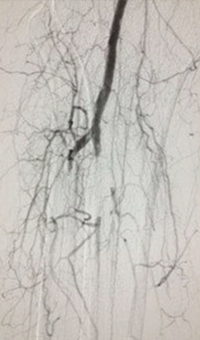 Case CLI with Right Foot Ulcer Thrombectomy pre-procedure arteriogram.